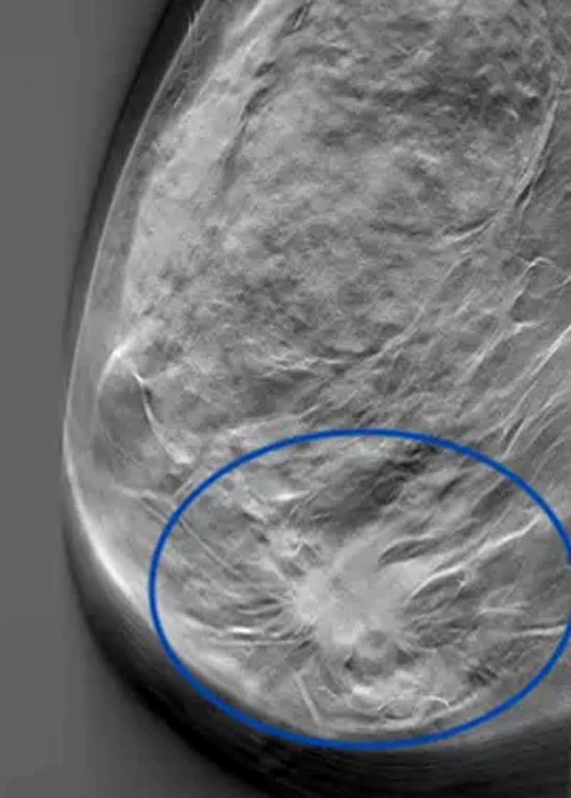 Bild på en brösttumör