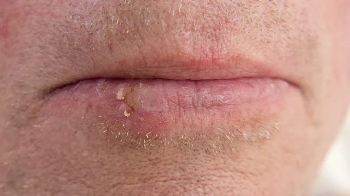 Närbild cancer på underläppen